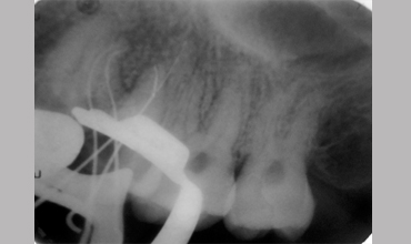 Teeth whitening in Anand
                            