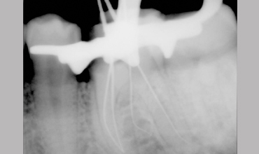 Dental jewellery treatment in Anand                        