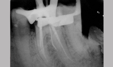 Preventative dentistry treatment in Anand                        